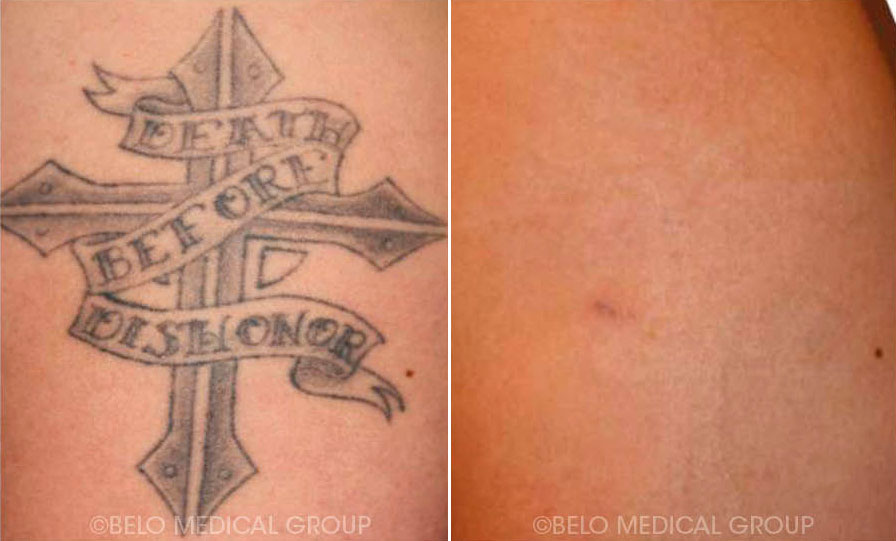 100+ [ Laser Tattoo Removal Process Cost ] Laser Tattoo 
