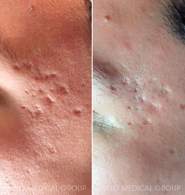 Acne Management and Acne Scars Gallery Belo Medical Group