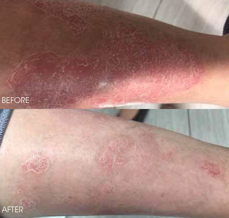 G-Max (GentleMax Pro) | Belo Medical Group