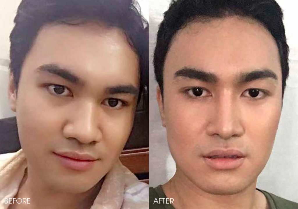 How Much Is Non Surgical Nose Job In Philippines Job Drop