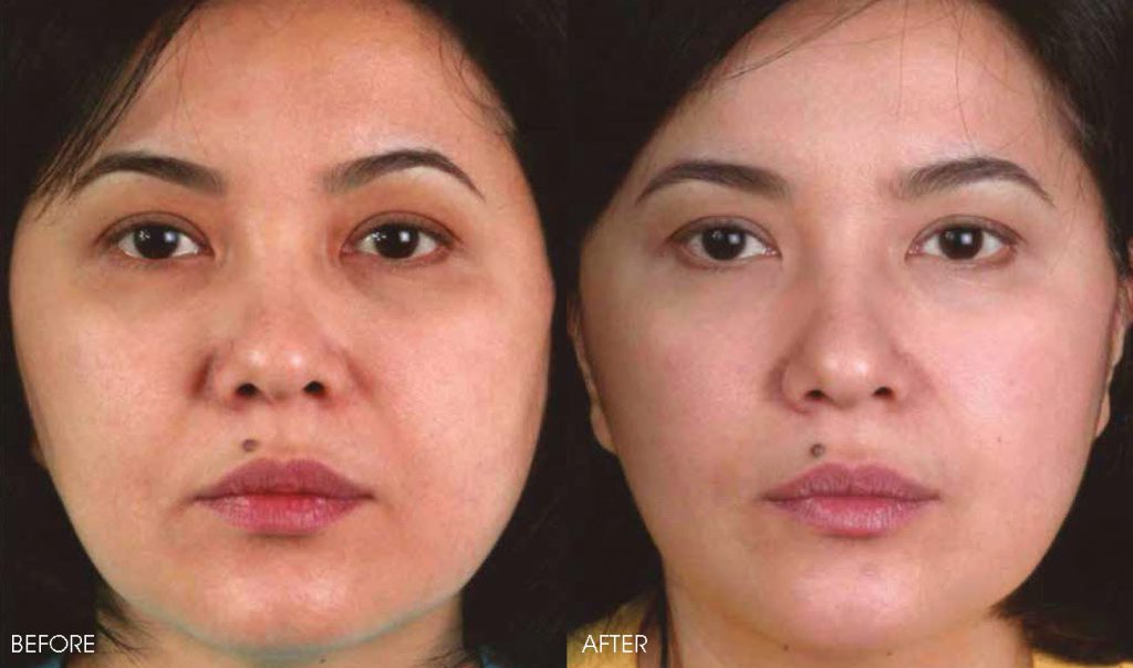 Thermage Treatment in the Philippines | Belo Medical Group
