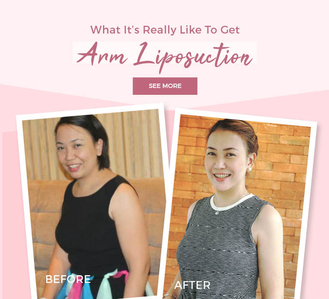 Arm Liposuction Treatment Belo Medical Group